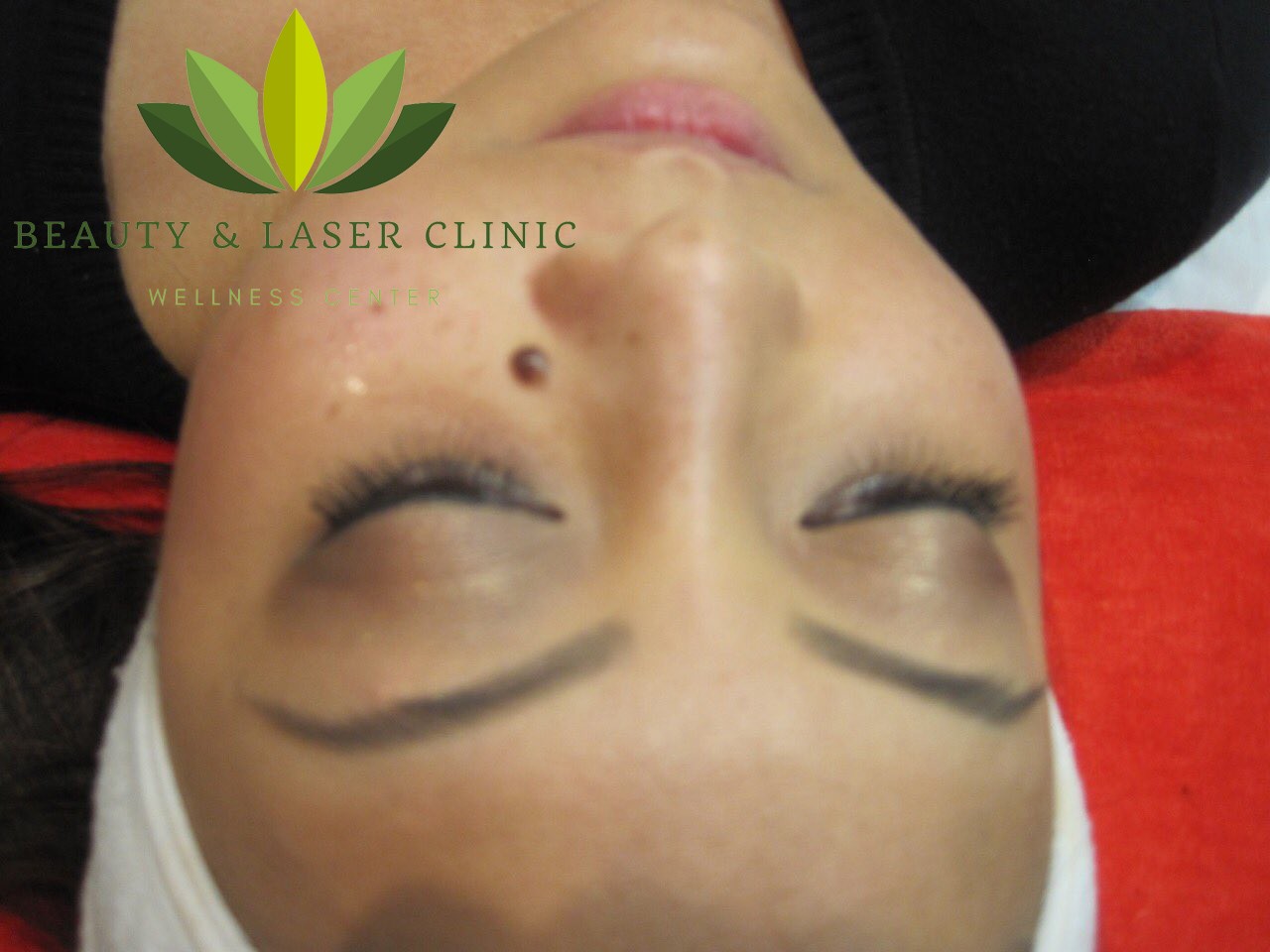 mole removal | Beauty and laser clinic before
