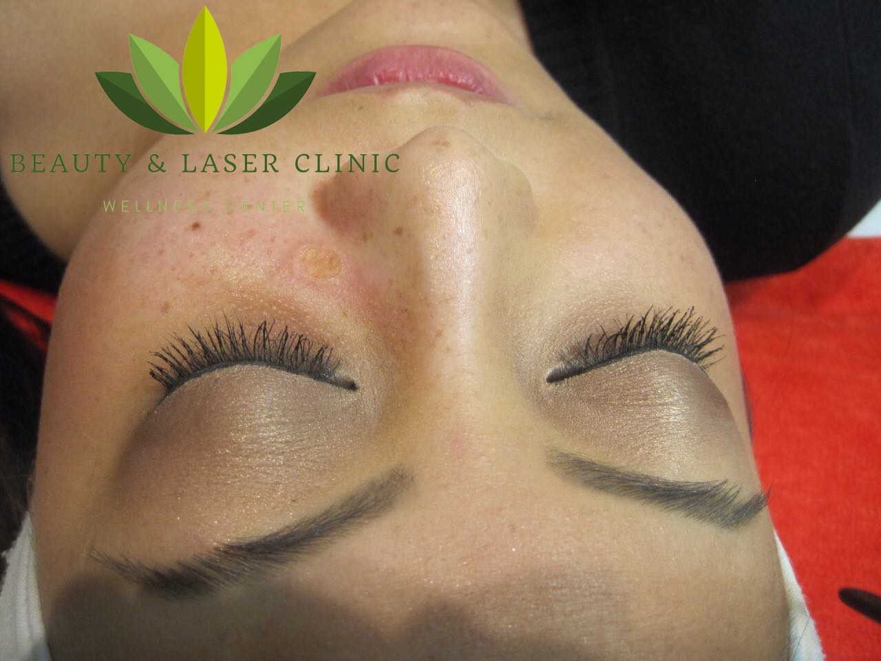 mole removal | Beauty and laser clinic After