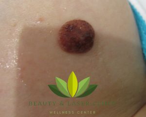 Body mole removal | Beauty and laser clinic SYDNEY MANLY