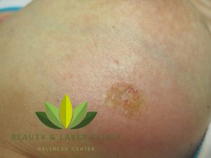 non surgical Body mole removal | Beauty and laser clinic SYDNEY MANLY 