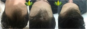 Micro needling Mesotherapy Hair loss Treatment