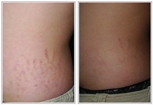 Stretch Marks (Striae) Treatment | Beauty and Laser Clinic